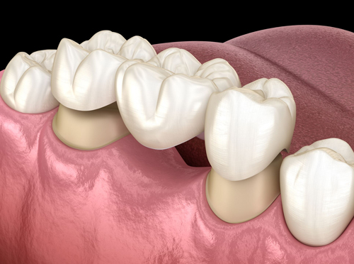 What Are Dental Bridges