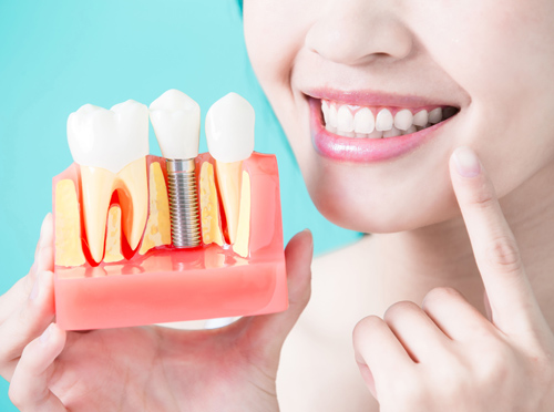 What Are Dental Implants