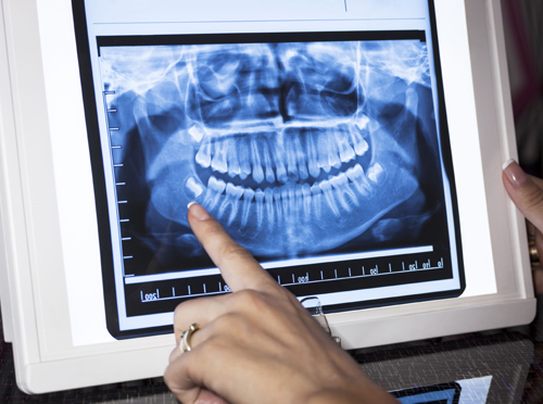 What Are Dental X Rays