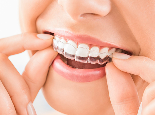 What Is Invisalign