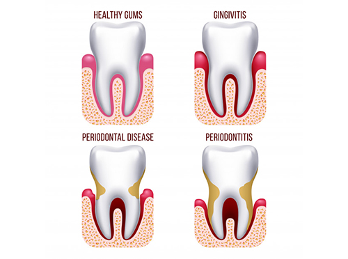 What Is A Periodontal Scaling And Root Planing