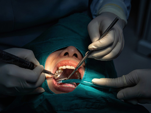 Why Is A Periodontal Scaling And Root Planing Needed