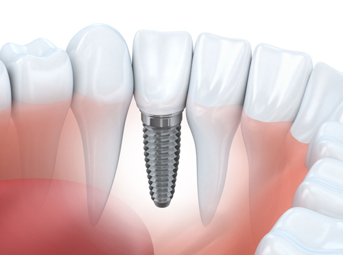 Why Would Dental Implants Be Needed