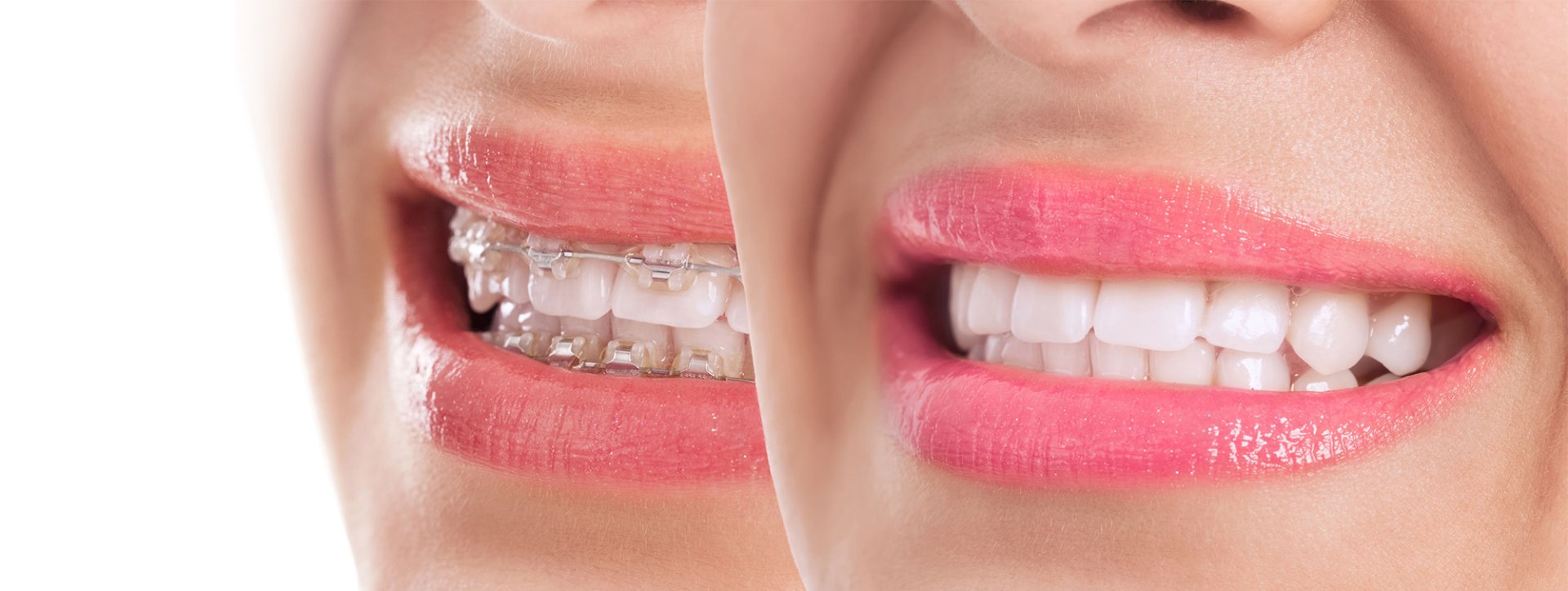 Things To Consider When Researching Invisalign Brace