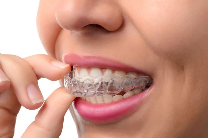 Things To Consider When Researching Invisalign Brace
